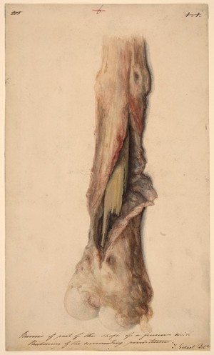 view Necrosis of the femur