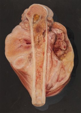 Sarcoma springing from the surface of the lower extremity of a femur