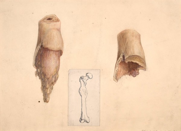 Central sarcoma of the shaft of the femur