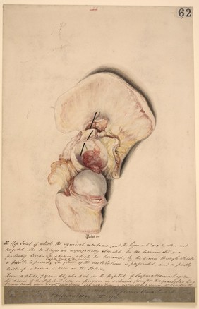 Hip joint with acute swelling of the synovial membrane and ligaments