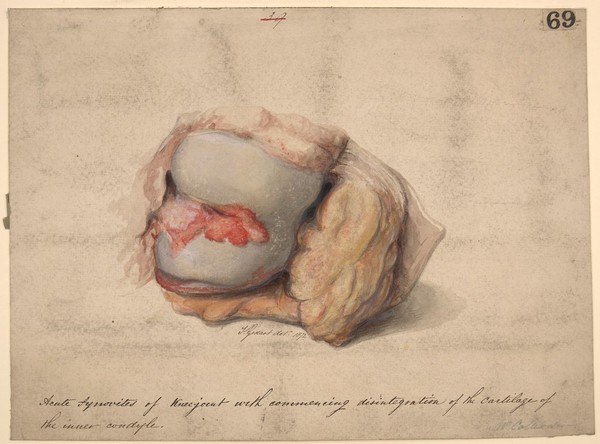 Acute synovitis of the knee joint