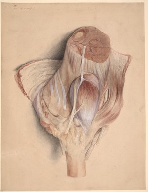 view Popliteal space, showing an intermuscular synovial cyst