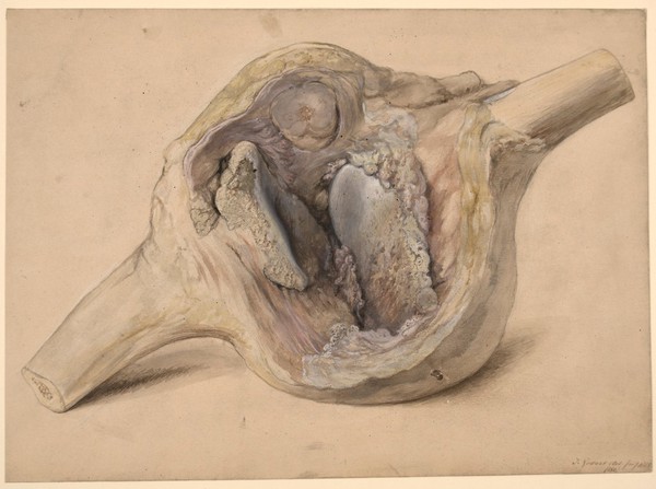 Dissected knee joint, the subject of marked locomotor ataxy