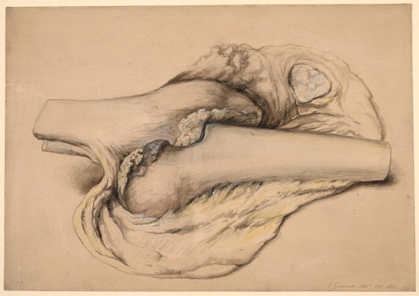 Dissected knee joint the subject of marked locomotor ataxy