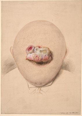 Child's head with depressed fracture of the parietal bone and subsequently a hernia cerebri