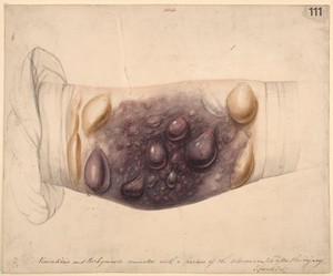 view Vesications and ecchymosis connected with a fracture of the olecranon