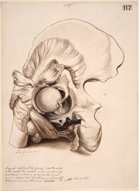 Dissected hip joint showing a recent dislocation of the femur backwards