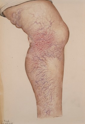 Extensive varicose veins affecting the leg