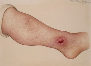 view Ulcer on the ankle