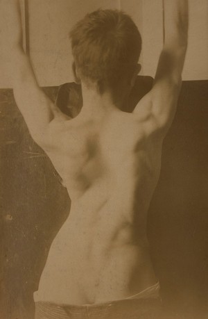 view Back of a youth showing the falling in of the chest after empyema