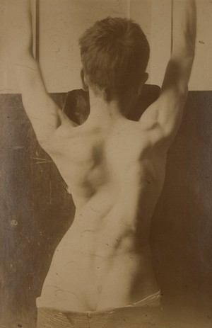 view Back of a youth showing the falling in of the chest after empyema