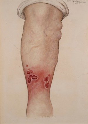 view Ulceration of the lower leg