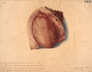 view Acute haemorrhagic pericarditis