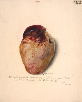 Right auricle and ventricle of the heart