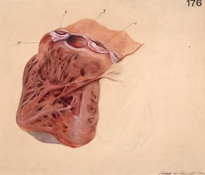 view Dilation of the right ventricle of the heart