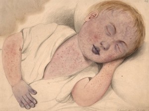 view Child with measles modified by cyanosis