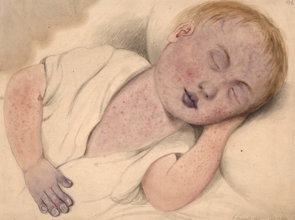 Child with measles modified by cyanosis