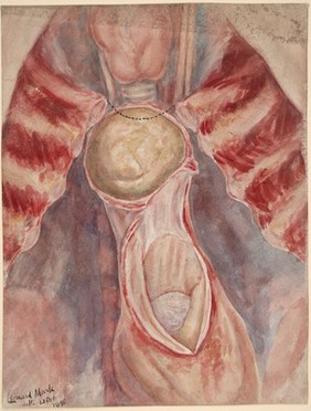 Aneurysm of the arch of the aorta