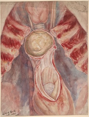 view Aneurysm of the arch of the aorta