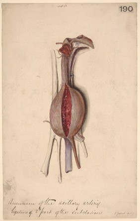 Aneurysm of the axillary artery filled with blood-clot after ligature of the subclavian artery