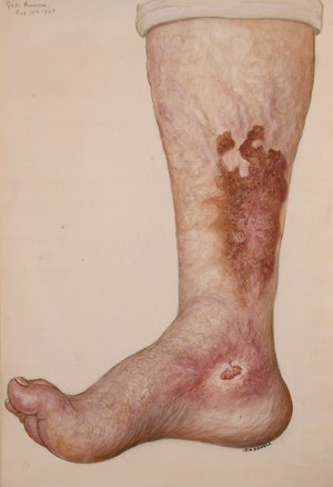 view Healing ulcers on the lower leg