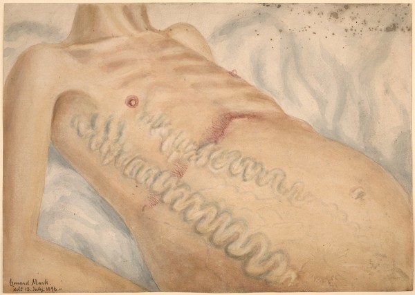 Varicose veins along the right side of the trunk of a man