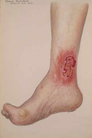 view Ulceration on the ankle