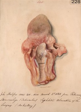 Syphilitic ulceration of the larynx