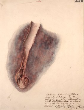 Dilatation of a bronchial tube in the lower lobe of a lung