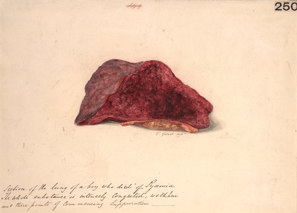 Lung of a boy who died of pyaemia