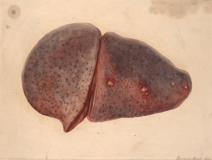 Lung with pyaemic abscesses