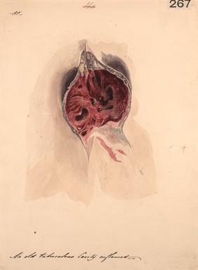 Inflammation of an old tubercular cavity of a lung