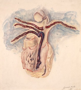 Thrombosis of the pulmonary artery