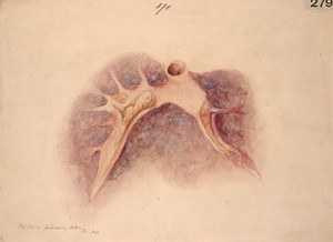 view Old clot in the pulmonary artery