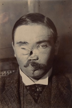 Face of a man whose nose had been reconstructed after a gun explosion