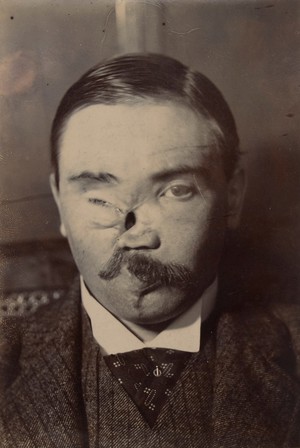 view Face of a man whose nose had been reconstructed after a gun explosion