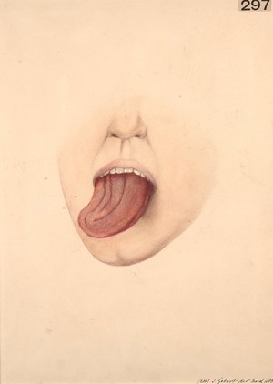 view Unilateral atrophy of the tongue