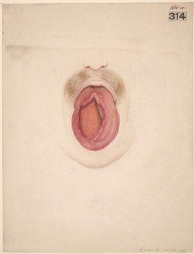 Gummatous ulceration of the tongue