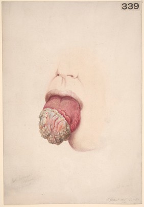 Cancer of the tongue