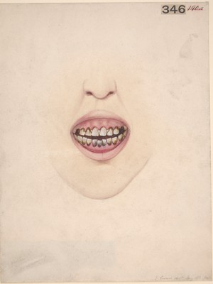 view Mouth of a gouty patient