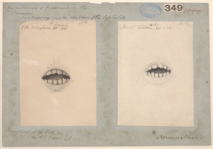 view Teeth from two patients with congenital syphilis