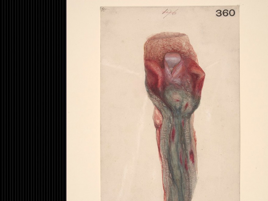 Oesophagus from a case of sulphuric acid poisoning.  St Bartholomew's Hospital Archives & Museum. CC BY 4.0