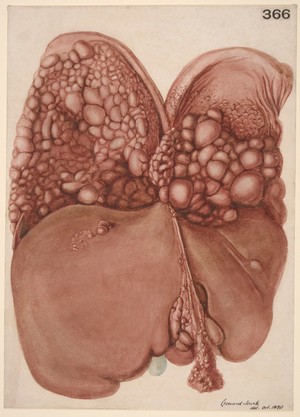 view Liver and diaphragm covered in pedunculated growths