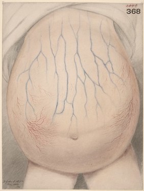 Abdomen of child affected with ascites