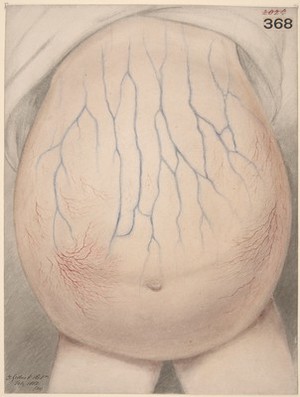 view Abdomen of child affected with ascites