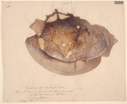 Spontaneous digestion of the stomach after death