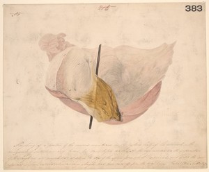 view Stomach and duodenum after poisoning by a mixture of nitric and sulphuric acids