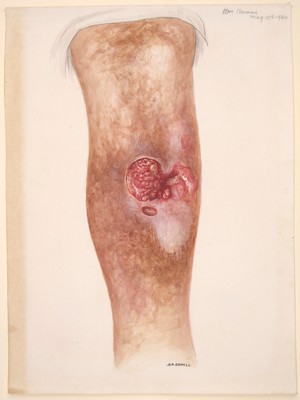 view Ulceration of the leg