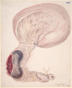 view Submucous haemorrhage of the duodenum