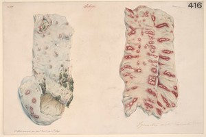 view Portions of the intestine, dysentery with typhoid fever